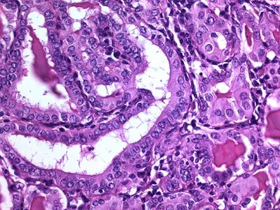 Susceptibility Genes and Chromosomal Regions Associated With Non-Syndromic Familial Non-Medullary Thyroid Carcinoma: Some Pathogenetic and Diagnostic Keys